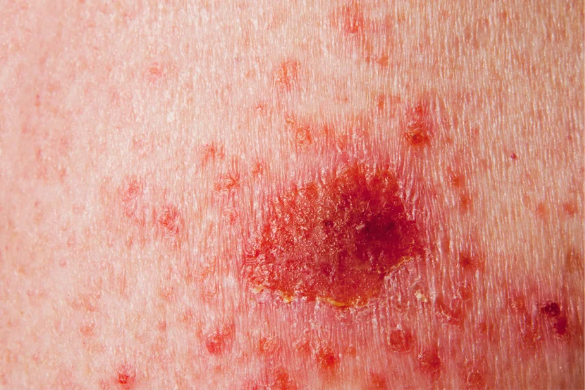 Photograph of a melanoma skin cancer.