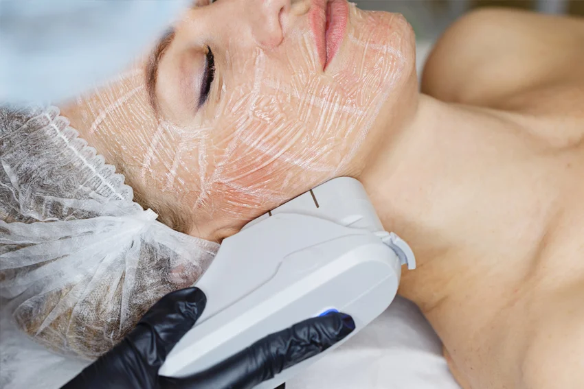 Photograph of skin tightening laser treatment.