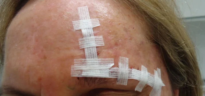 Sometimes you may need a larger than expected wound to achieve the best final result.