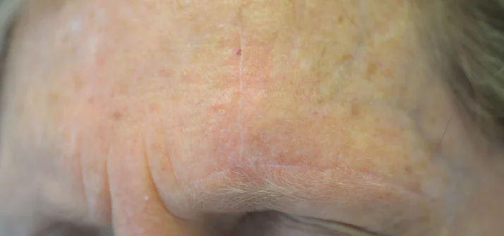 The final scar is placed in existing skin creases.