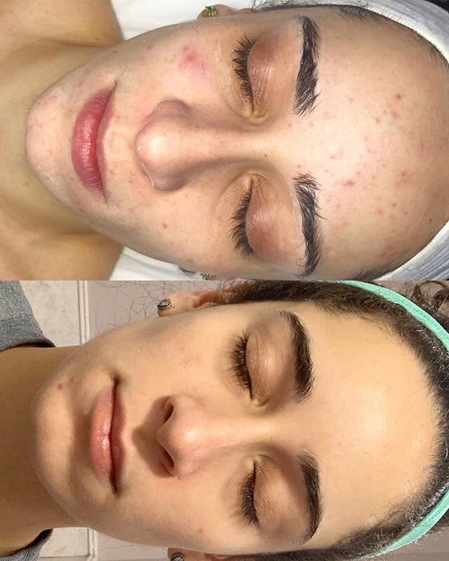 ACNE BOOTCAMP CLIENT RESULTS😍⁣⁣
⁣⁣
I&rsquo;m so proud of this beauty! Her dedication and consistency to achieving clear skin is why she will have long lasting results for years to come! ⁣⁣
⁣⁣
The main focus behind our facial treatments was to reduce