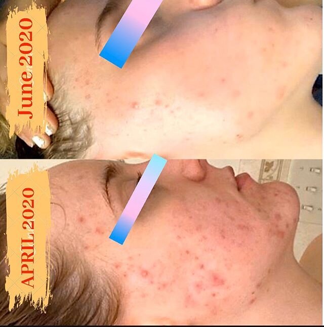 VIRTUAL CLIENT PROGRESS PHOTO😍⁣⁣⁣
⁣⁣⁣
Can you believe these results are only 3 months apart just from changing her at home skin care routine? ⁣⁣⁣
⁣⁣⁣
⁣⁣⁣
In the before photo, her skin was red and irritated due to a compromised skin barrier. After sw