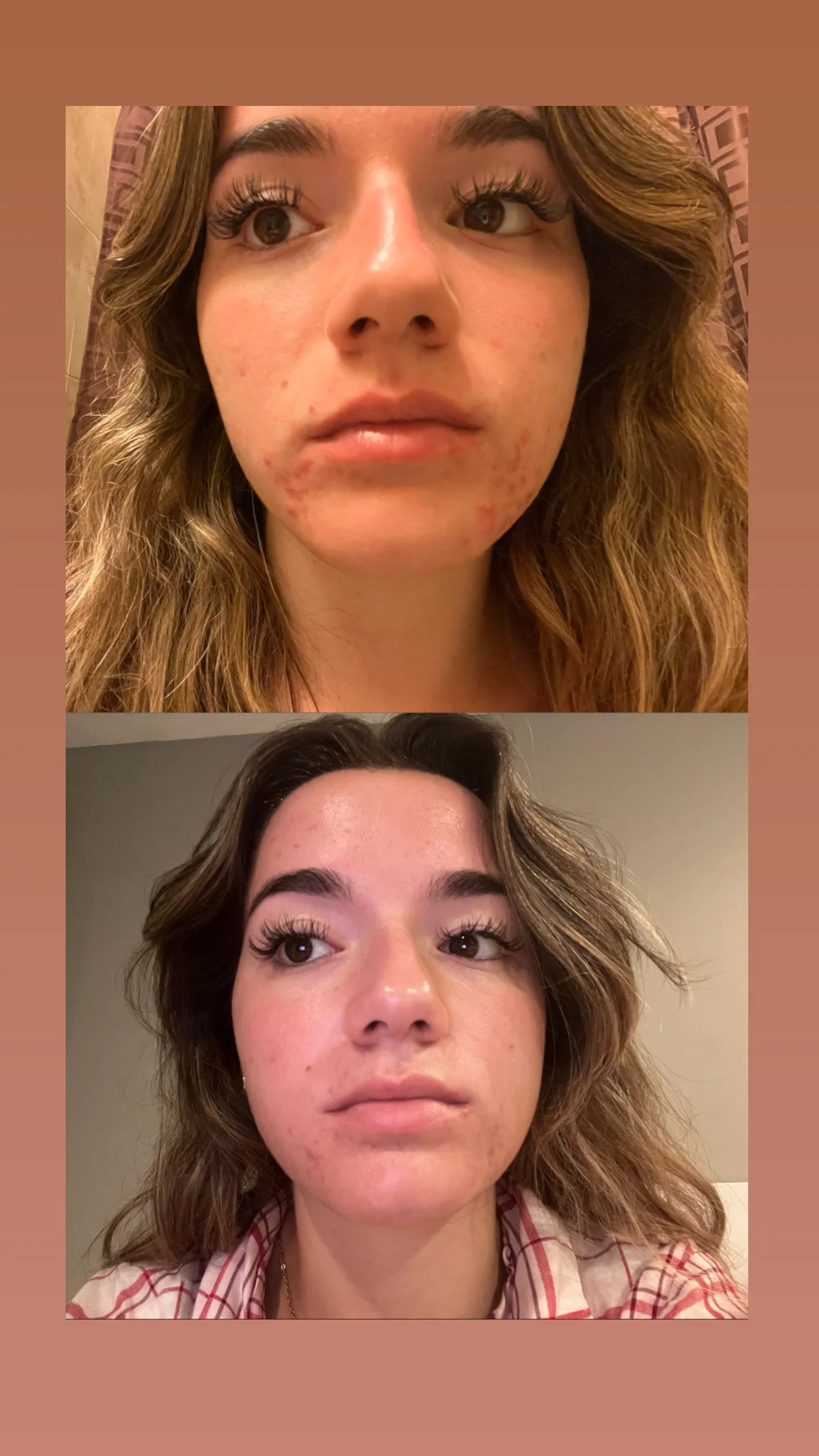 Healing Skin From Within Acne Facial Near Me