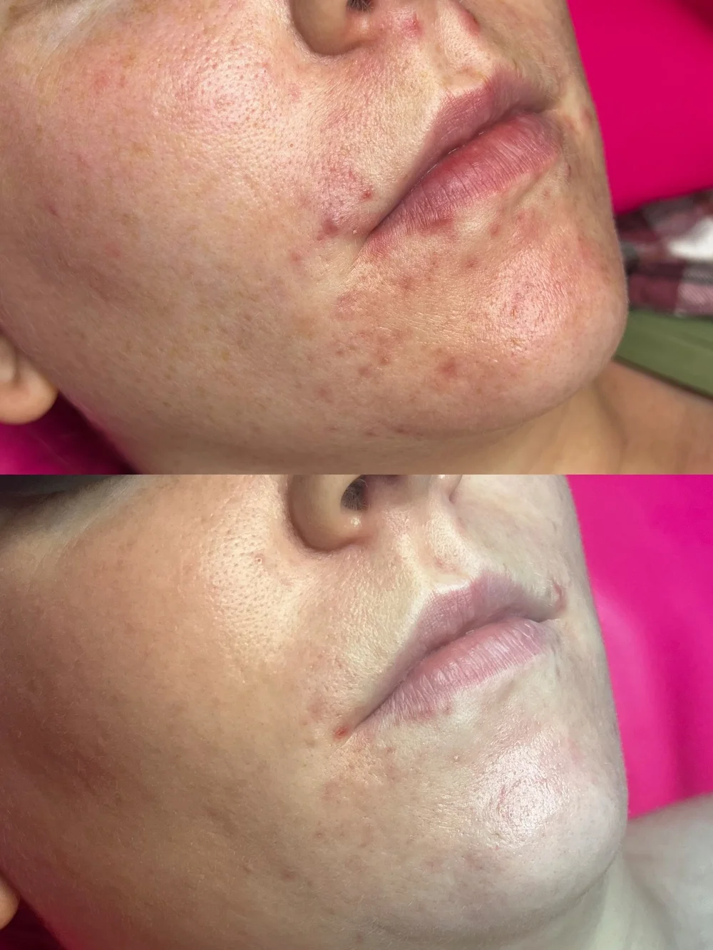 Healing Skin From Within Acne Facial Near Me