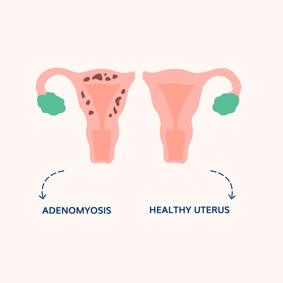 Adenomyosis is a condition in which endometrial tissue exists within and grows into the uterine wall. It usually happens late in childbearing years and disappears after menopause.