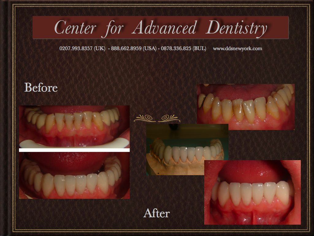 Center for Advanced Dentistry before & after