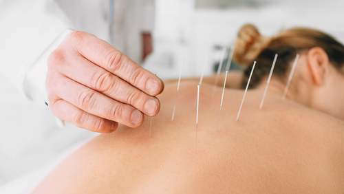 acupuncture+for+anxiety