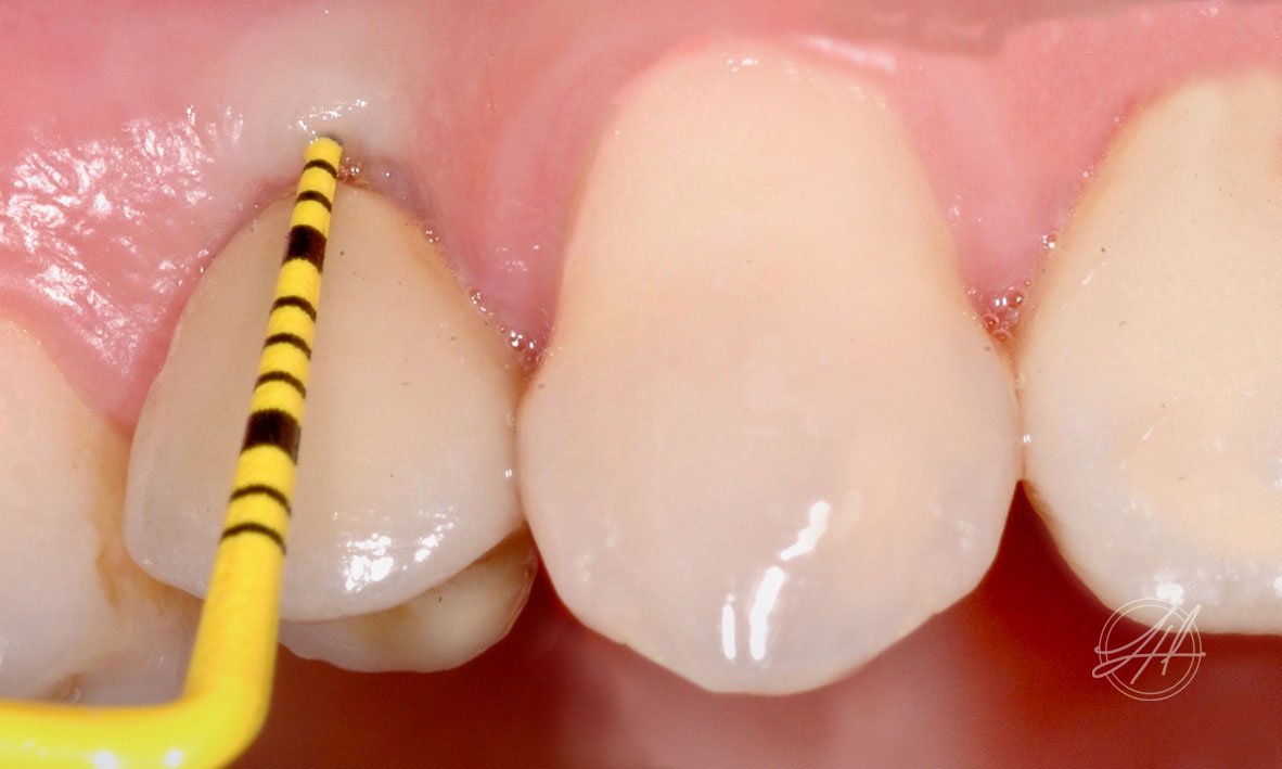 ©-Dr-Lizzy-Hui-Dentist-Conditions-Gum-Disease-Peri-Implant-Mucositis-02.jpg