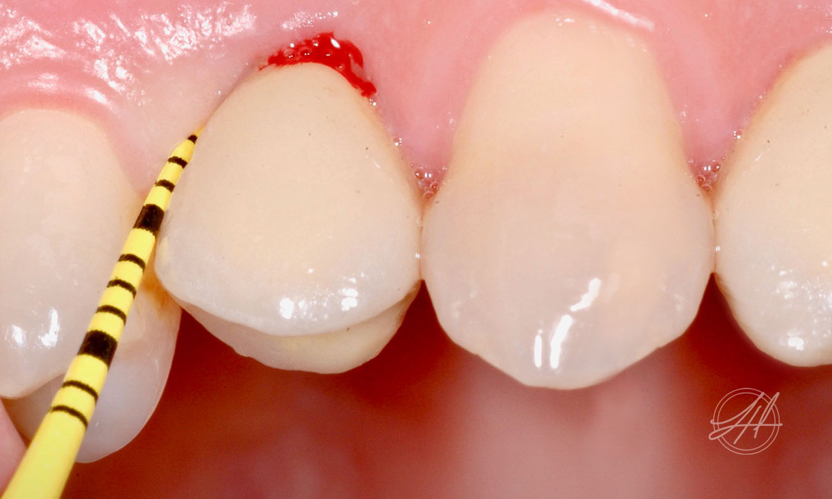 ©-Dr-Lizzy-Hui-Dentist-Conditions-Gum-Disease-Peri-Implant-Mucositis-01.jpg
