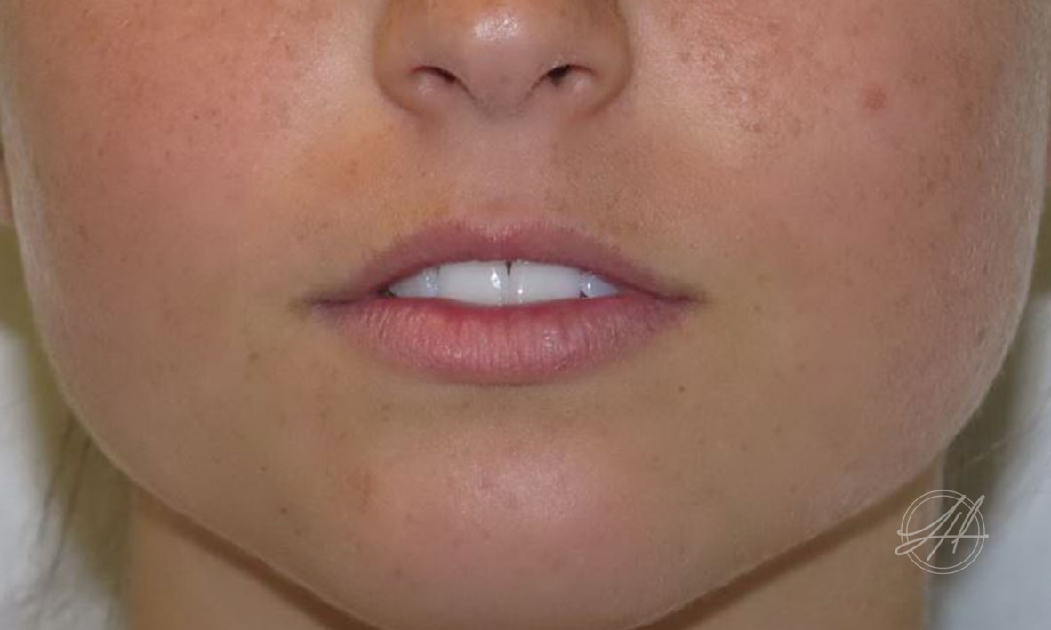 Thin or Asymmetrical Lips