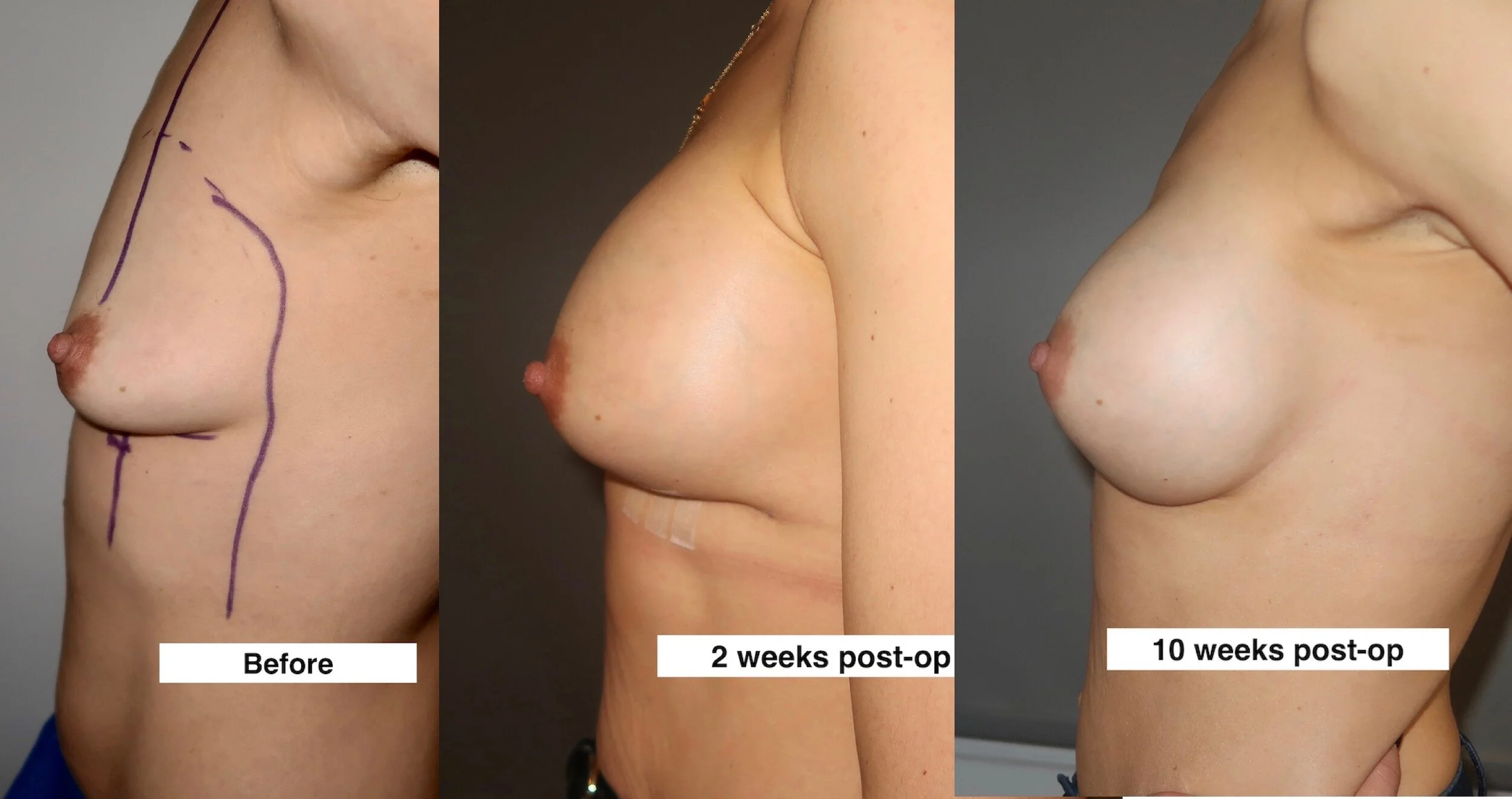 The "Drop and Fluff" process after Breast Augmentation