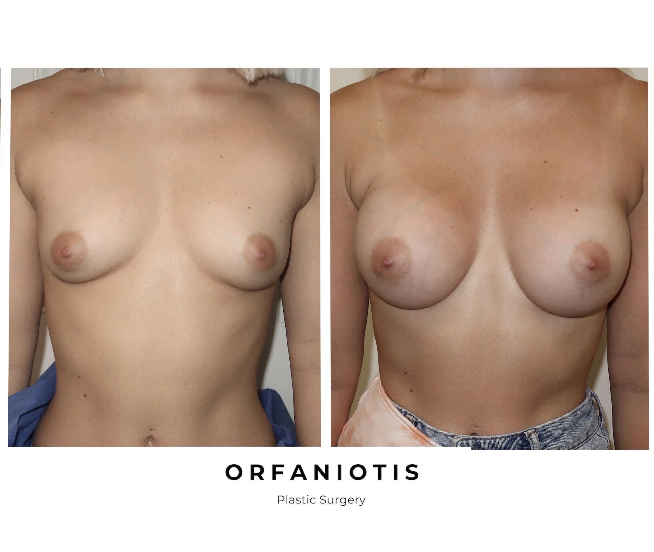 Lori harvey breast implants