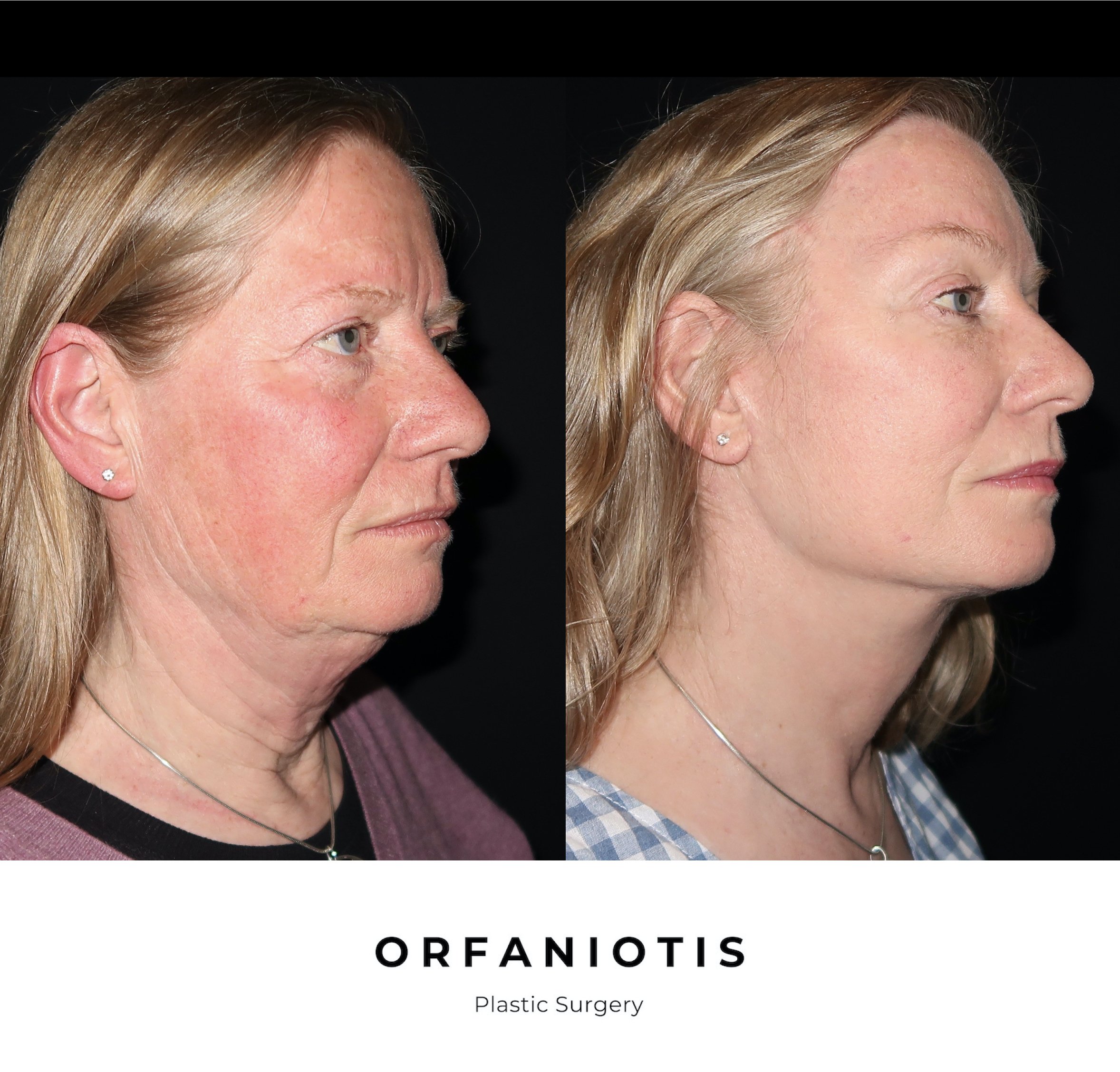 Deep Plane Facelift in London. Georgios Orfaniotis