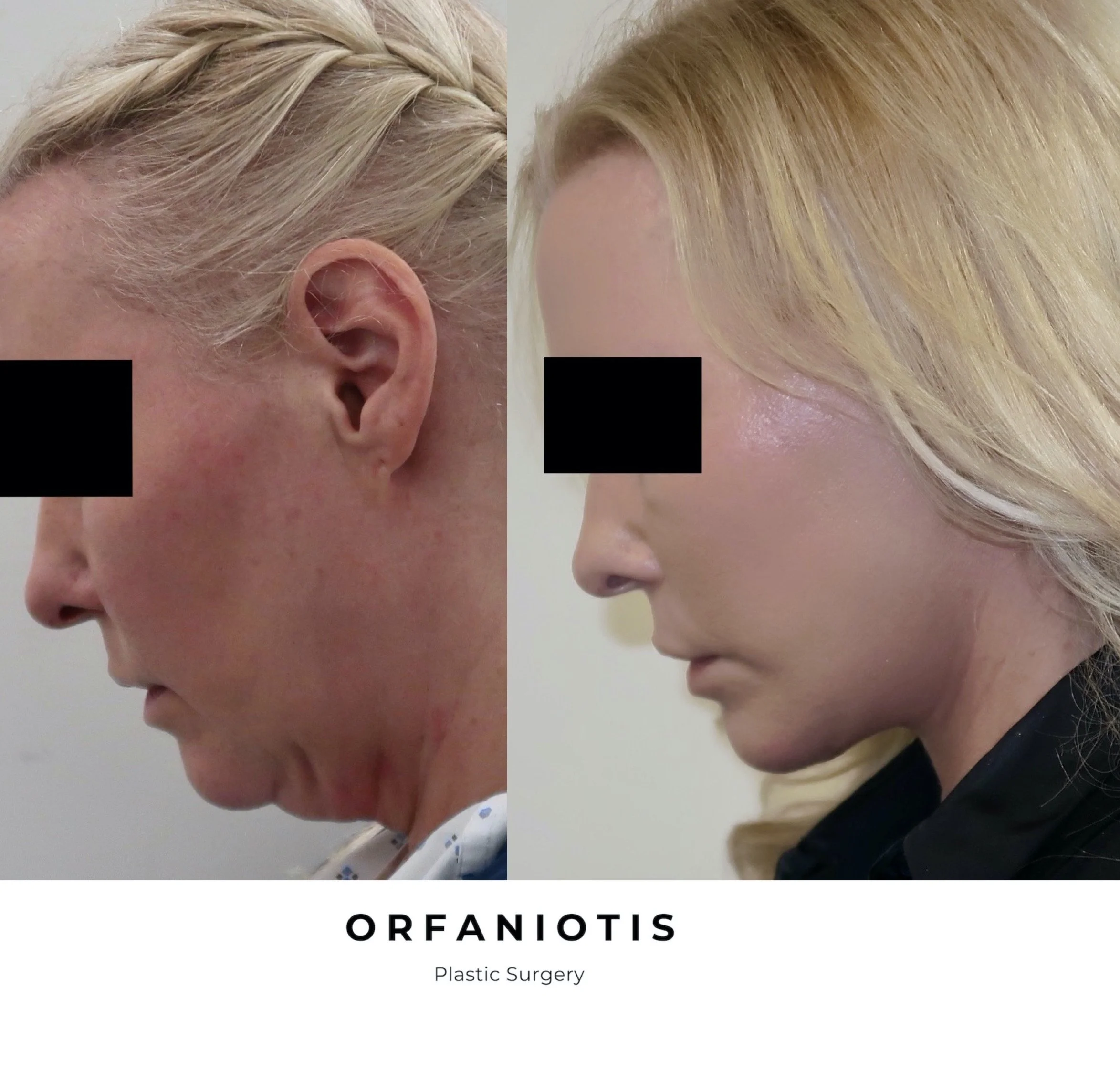 Deep Plane Facelift in London. Orfaniotis