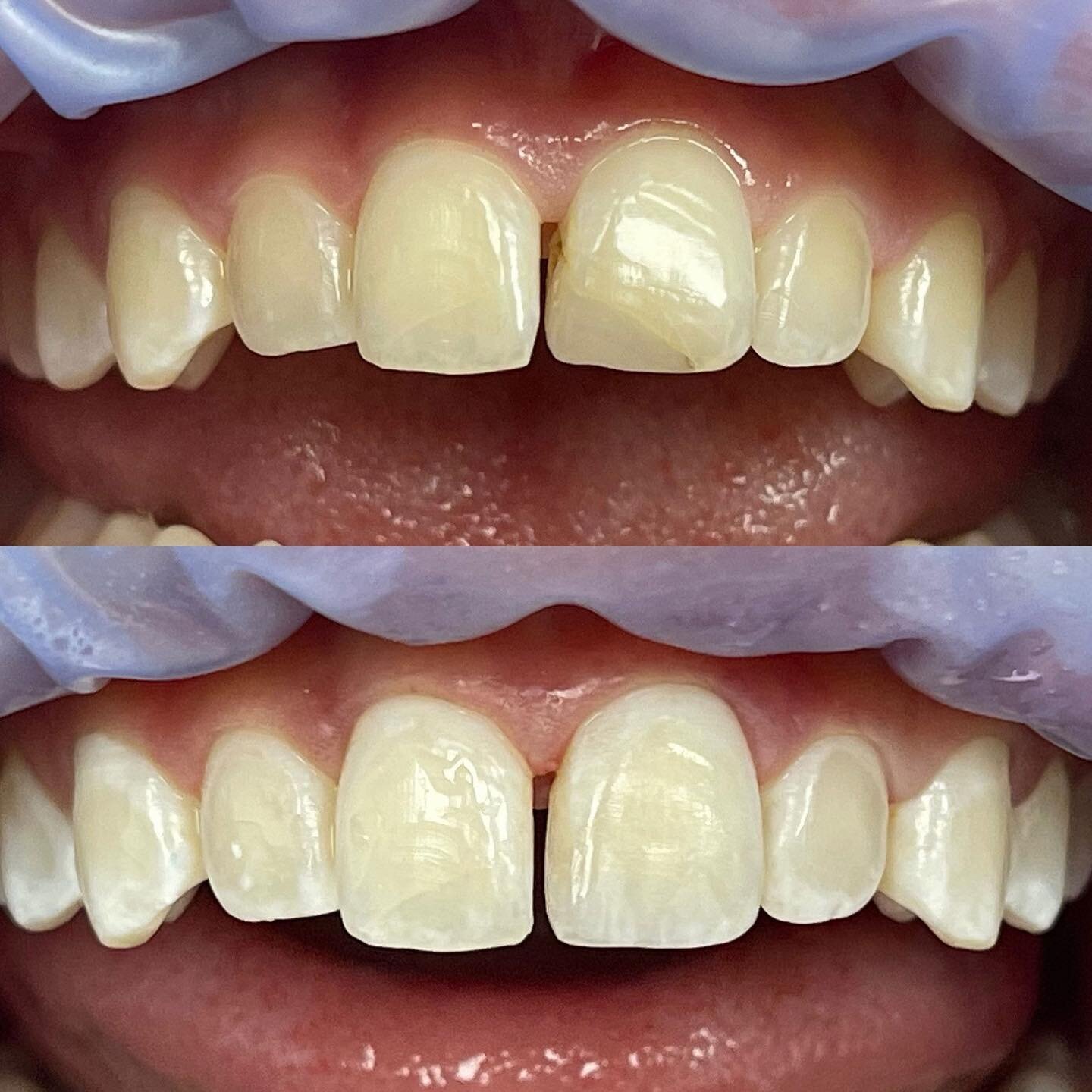 I love this #minimallyinvasivedentistry case. The patient didn&rsquo;t want to close the space but knew it was time to replace this composite they had done as a child after an accident. Under isolation I used a Bioclear matrix to correct contour befo