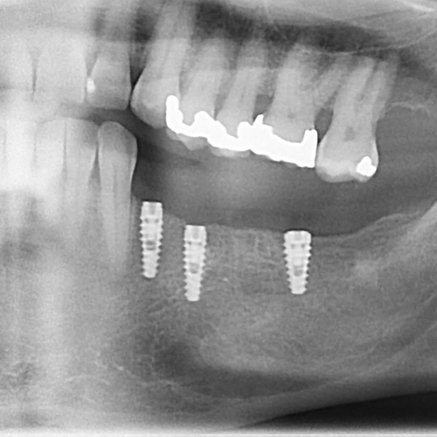 Sharing a few implant cases I&rsquo;ve placed and restored recently. In 2020 I invested in technology to surgically guide implants to remove guesswork, reduce risk of complications, and keep chair time for our patients as short as possible. Can I fre