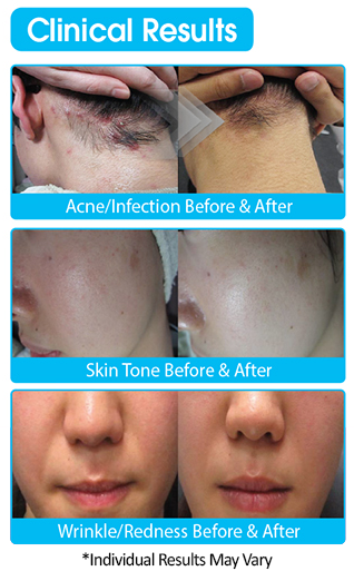 Clinical-Results-Hydroimpact.png