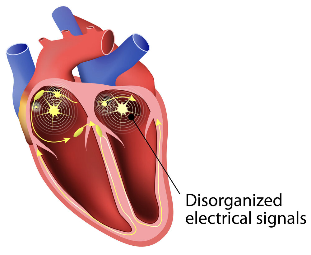 [Risk of arrhythmias and cardiac complications after electrical injury]