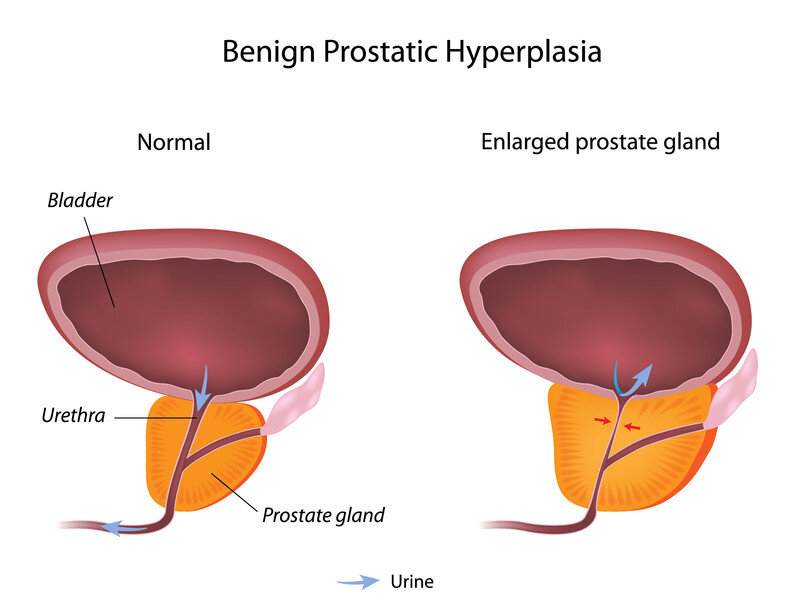 yaourt et prostate