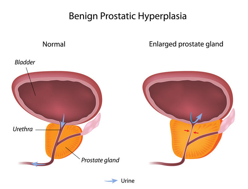 prostatita și lyapko ce înseamnă remisia prostatitei cronice?