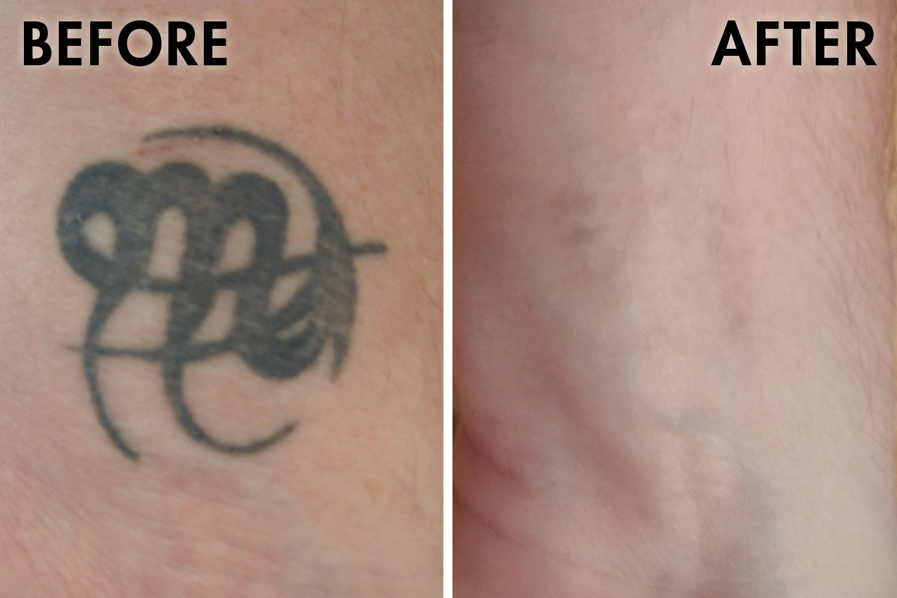Why Tattoo Removal Can Leave Scars  And How to Avoid Them  Certified  Tattoo Studios