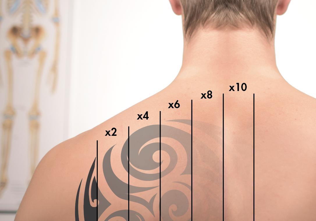 Laser Tattoo Removal - Colorado — No Regrets Laser Services