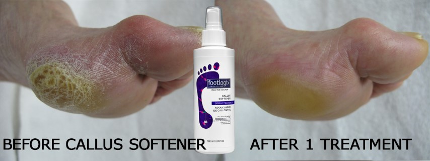 The DO'S & DONT'S of Callus Removal — Footlogix Australia