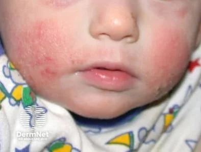 Eczema