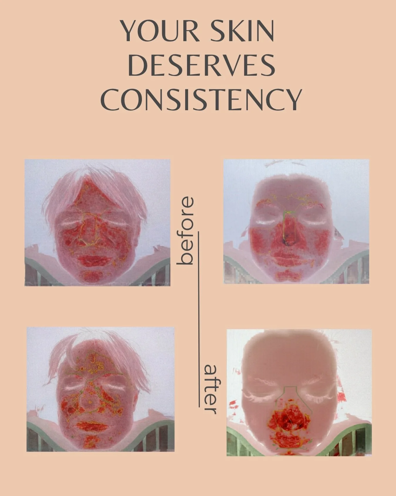 Healthy skin isn&rsquo;t built in one treatment

Consistency matters: 
Professional treatments, homecare, skin education and a plan designed for your skin.
Weather your focused on ageing, pigmentation, acne or hydration, every treatment at Sibu skin 