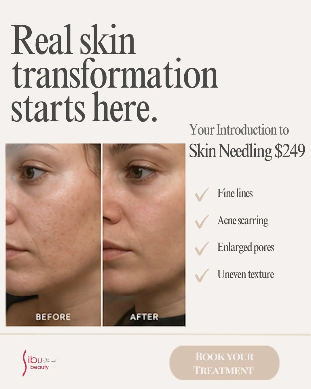 Real skin transformation starts here.

Skin Needling supports collagen renewal to improve texture, tone and overall skin quality, helping to visibly refine acne scarring, enlarged pores, uneven texture and fine lines.

If you&rsquo;ve been thinking a