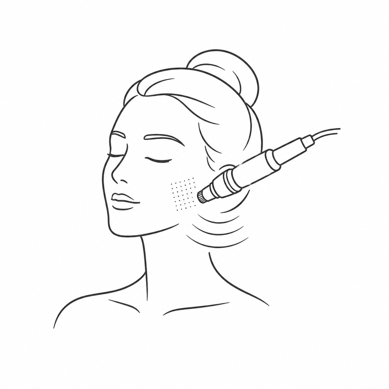 Skin Needling enhancement for selected RF and HIFU treatments