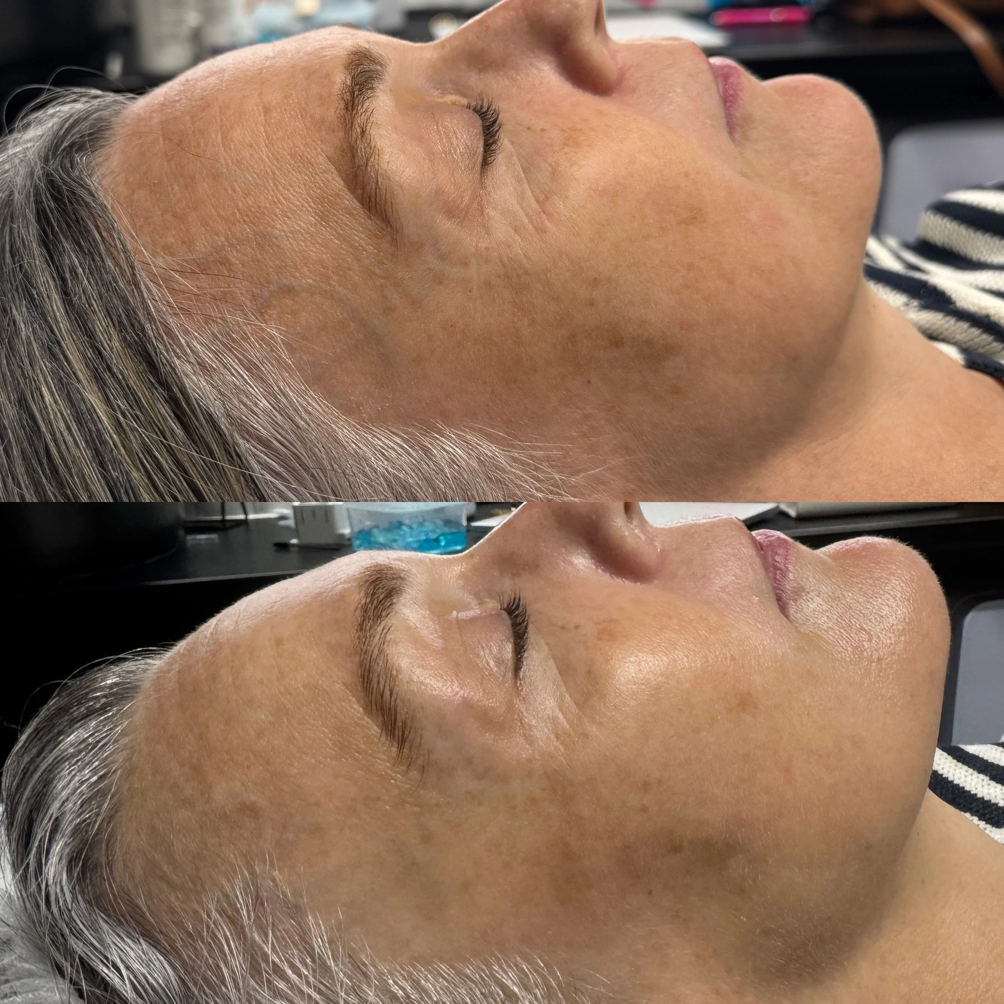 Before and after HIFU skin tightening showing improved skin firmness and smoothing through the upper face.