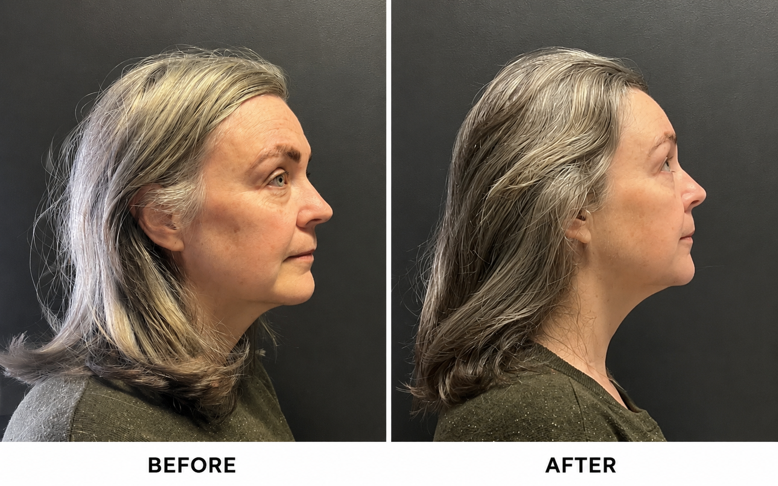 Before and after HIFU skin tightening showing improved firmness and definition through the jawline and lower face.