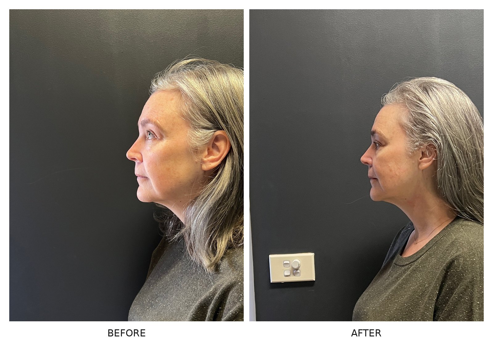 Before and after HIFU skin tightening showing improved firmness and contour through the jawline and lower face.