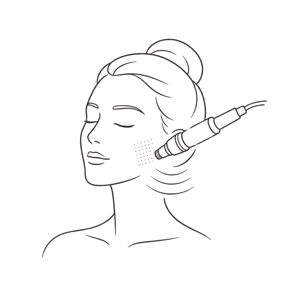 Skin needling treatment for collagen support and improved skin texture at Sibu Skin and Beauty Canberra