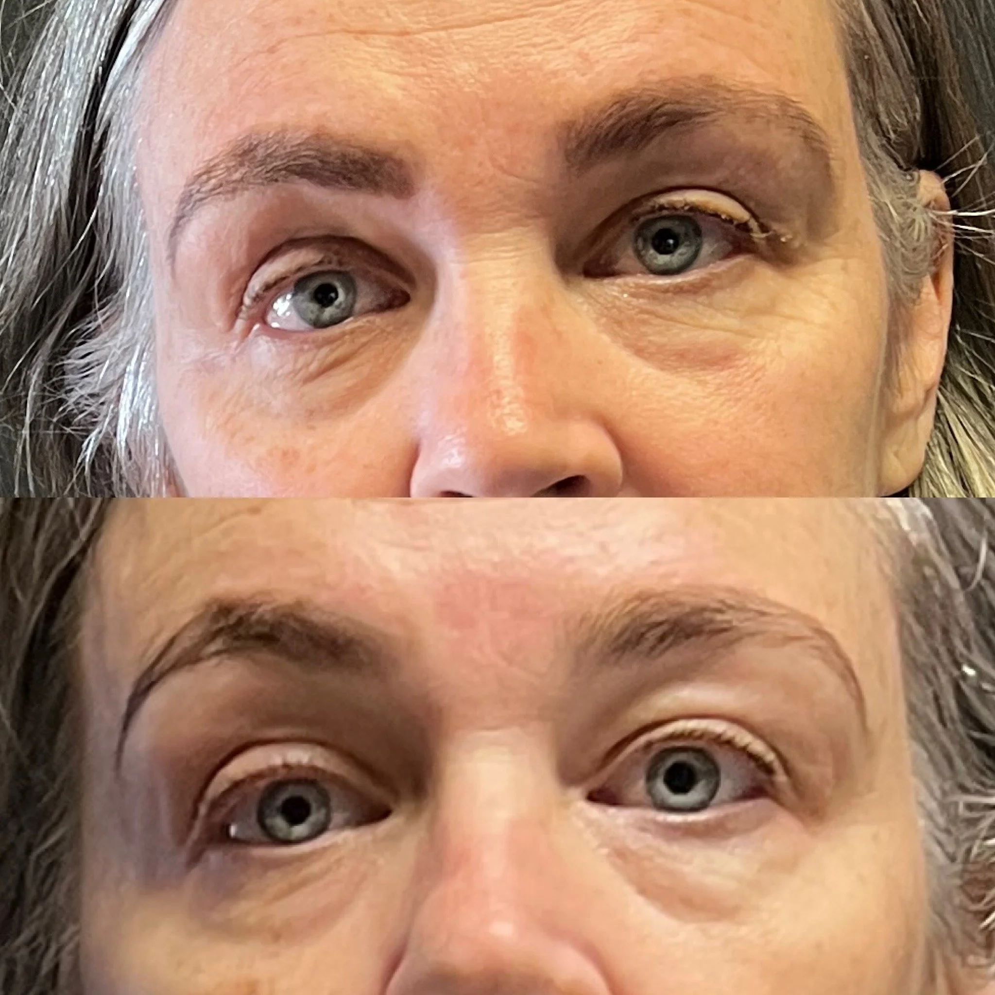 Before and after HIFU skin tightening showing improved skin firmness and refinement around the eye area.
