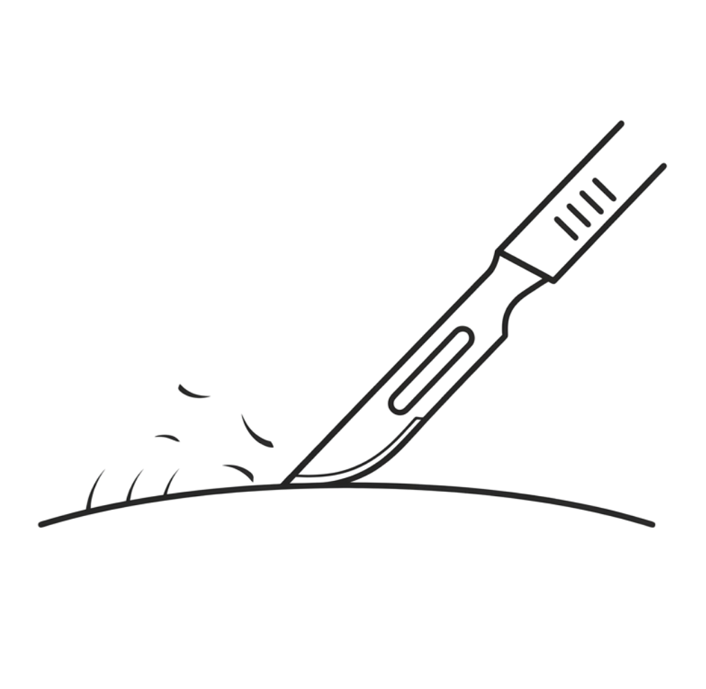 Dermaplaning treatment removing surface build-up and fine facial hair