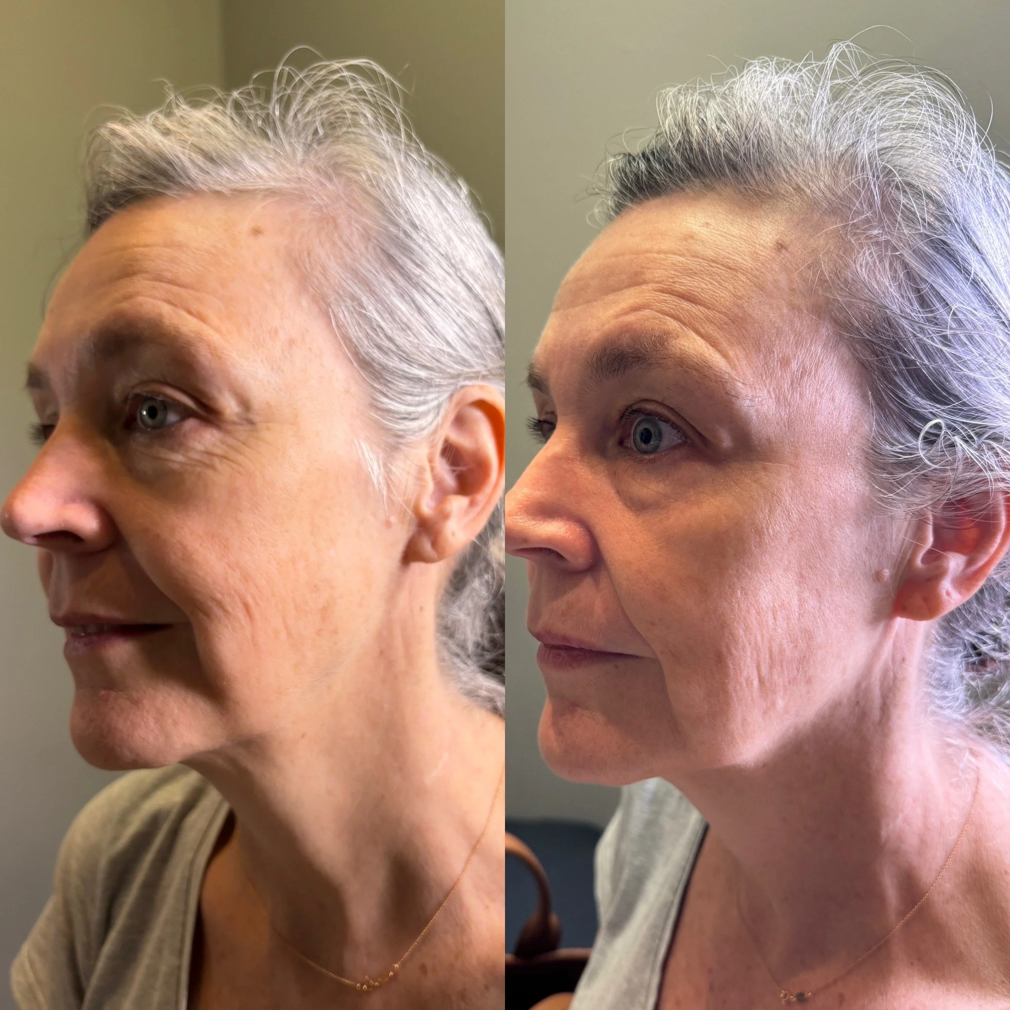 Before and after HIFU skin tightening showing improved jawline definition, contour and skin firmness.