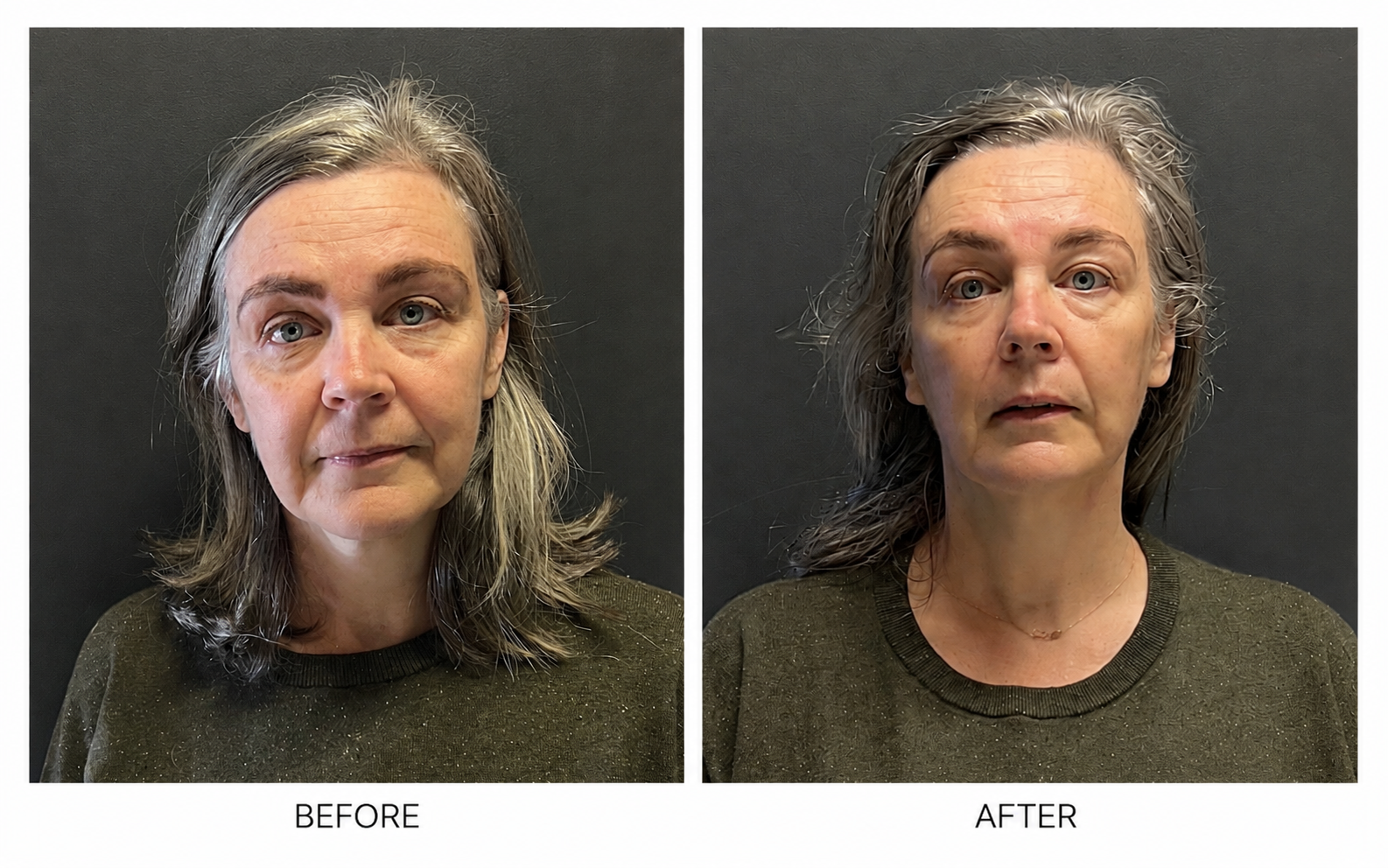 Before and after HIFU skin tightening showing improved overall facial firmness and definition.