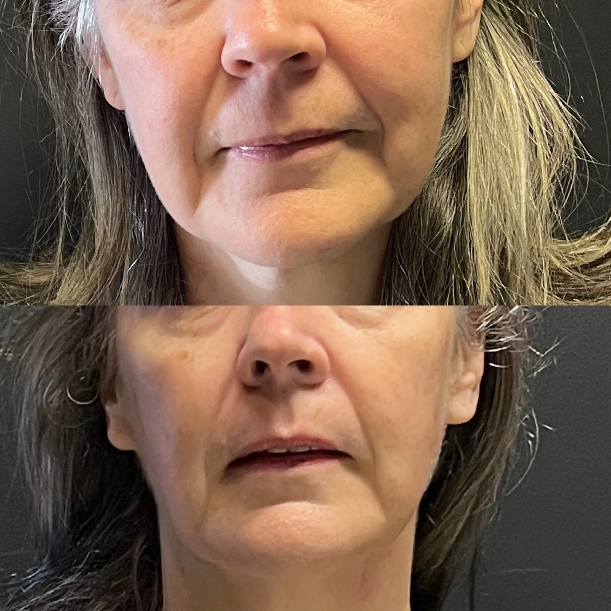Before and after HIFU skin tightening showing improved lower face contour and overall skin firmness.