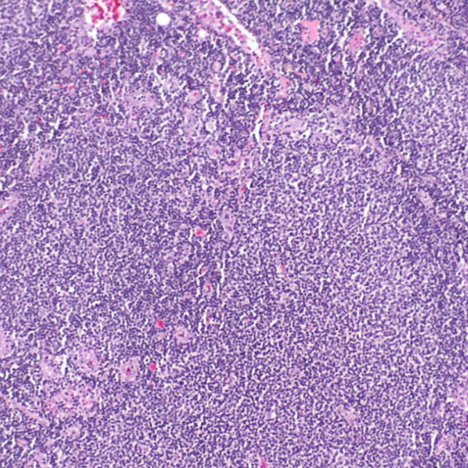Update: Follicular Lymphoma by Sarah Milgrom, MD and Rahul Parikh, MD