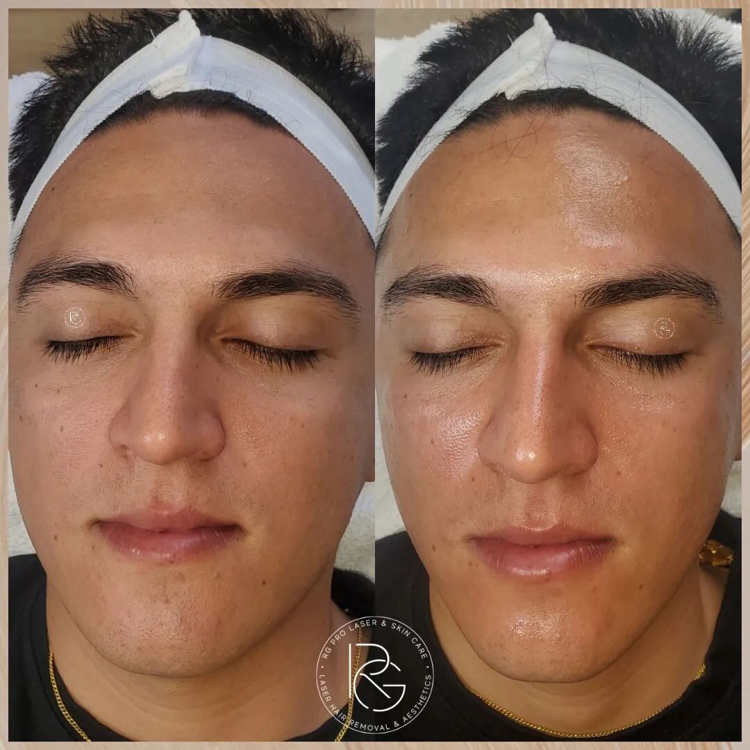 Refreshed and Rejuvenated🤩 What better feeling?! 👏💫💧#hydrafacial @hydrafacial 
.
.
.
.
.
.
.
.

Hydrafacial includes deep cleanse, exfoliation, mild chemical peel, extractions, hydration and protection for glowing skin! Then lastly LED light ther