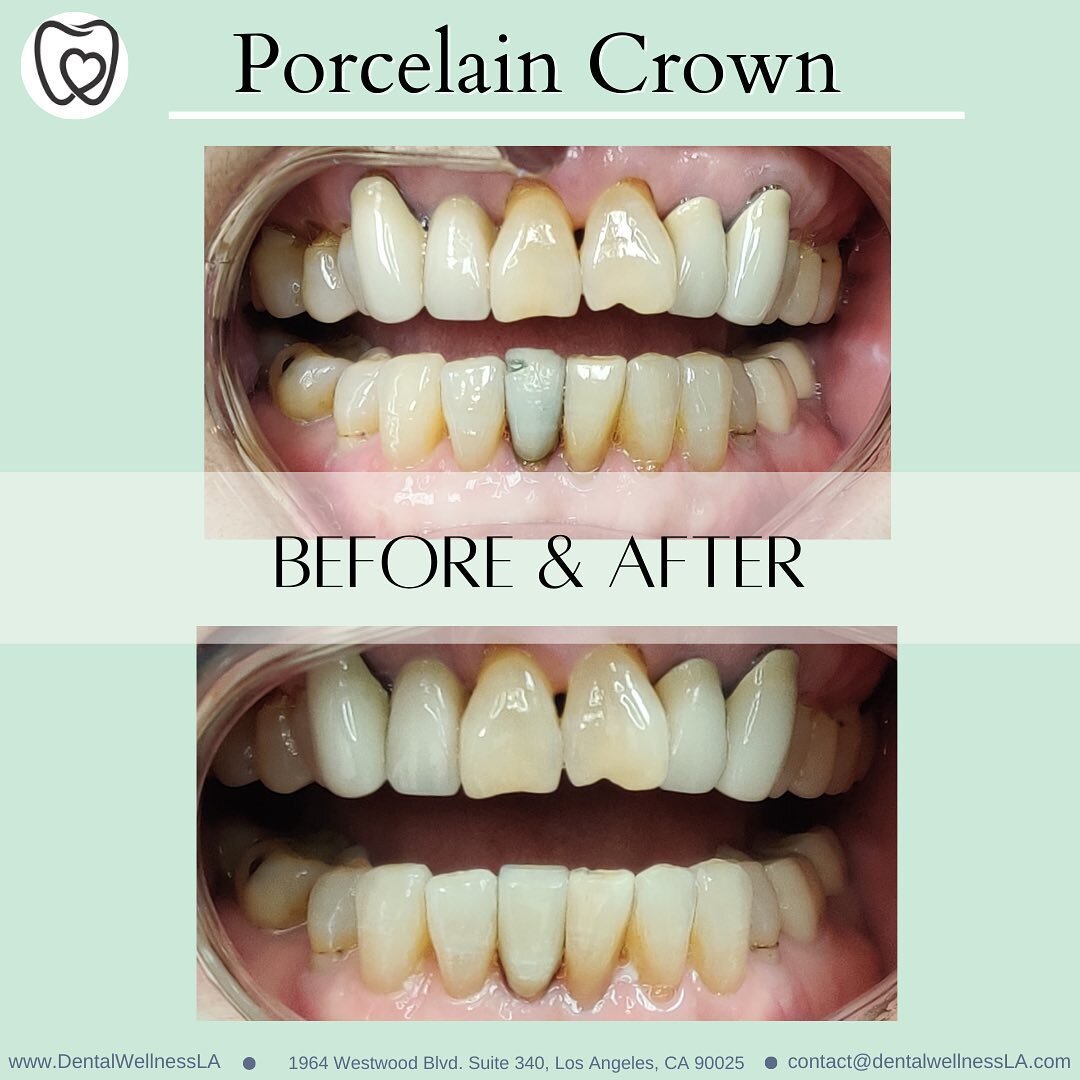 Another great Crown Restoration! This patient wanted to improve the health and esthetics of their teeth.
Look at these before and after pictures of this transformation! ✨✨ #dentalwellnessLa #westwood #La #dentistry #crowns #porcelian #restorations #h