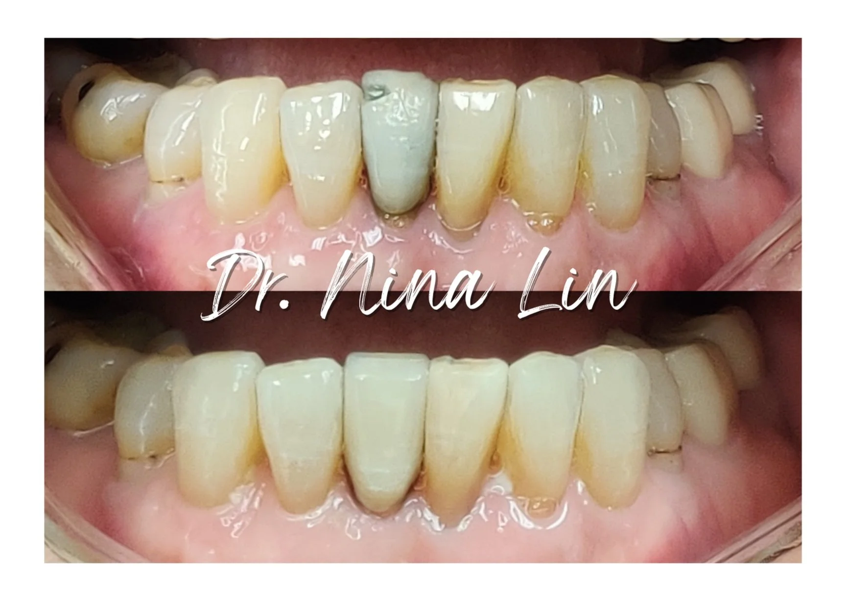 How Often Do Zirconia Crowns Need To Be Replaced