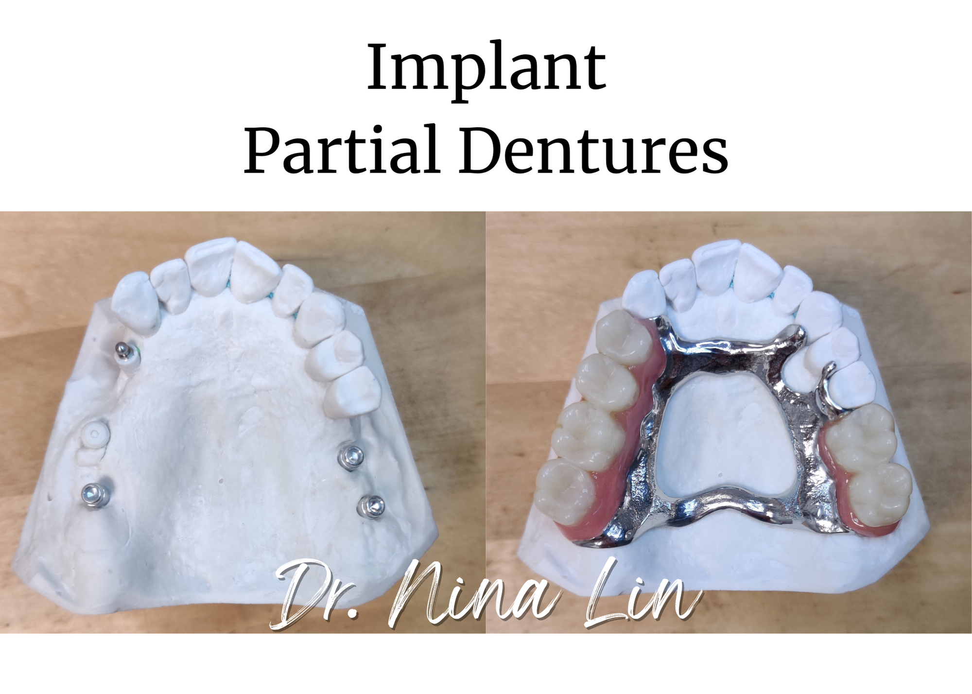 Implant Partial Dentures.png