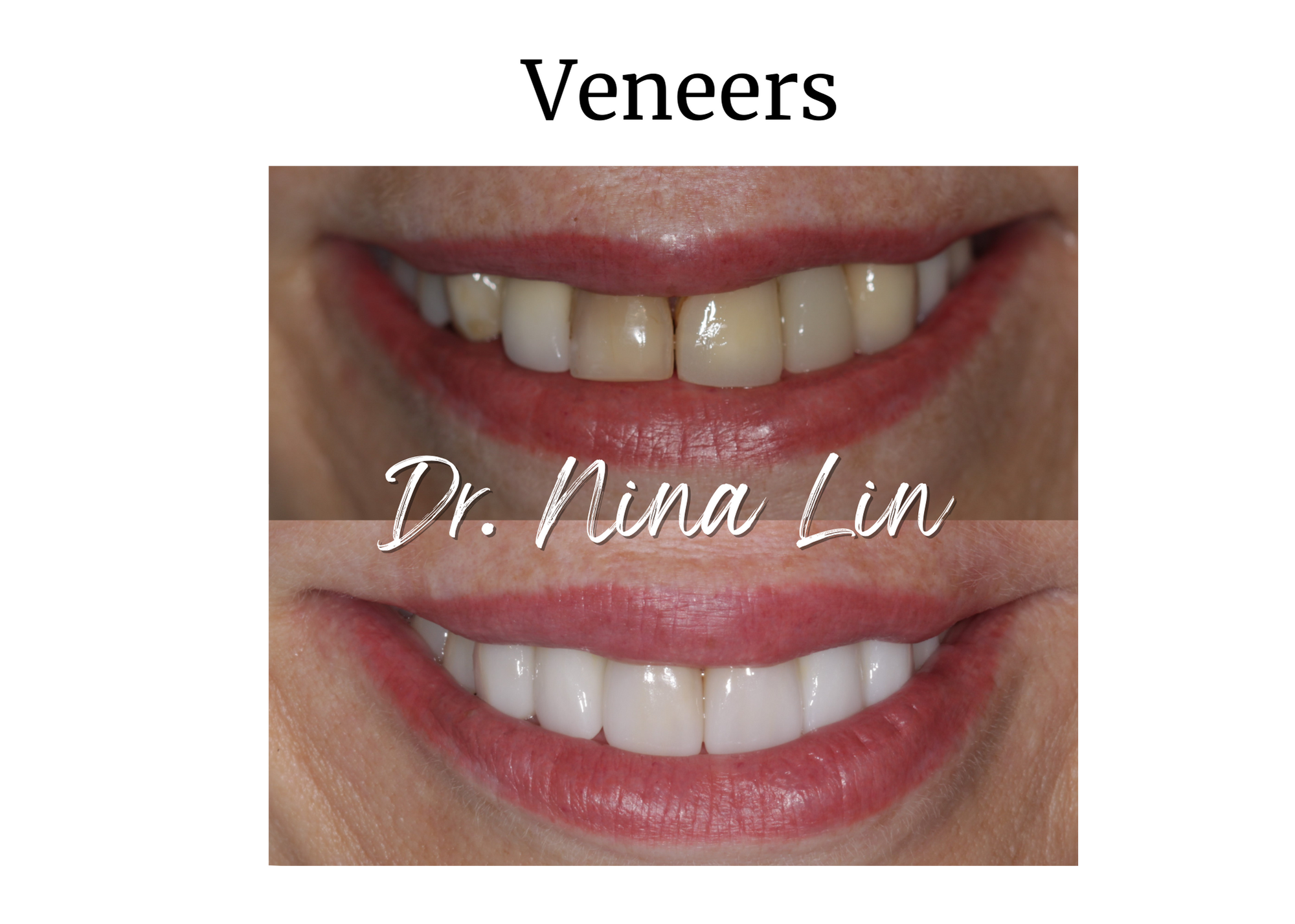 Veneers (1).png