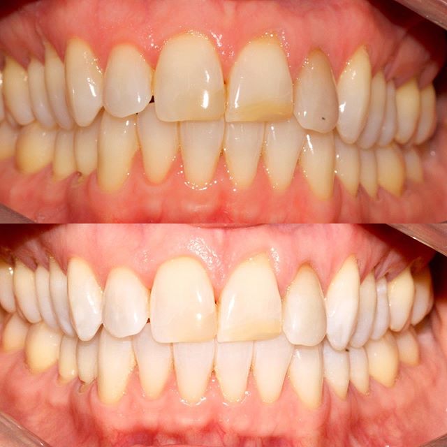 ***Enlighten whitening*** Guaranteed shade B1 ✅  No white diet ✅ (red wine 🍷 coffee ☕️ curry 🍛  will not affect results)
Lifelong results ✅  No fancy lights or special equipment ✅