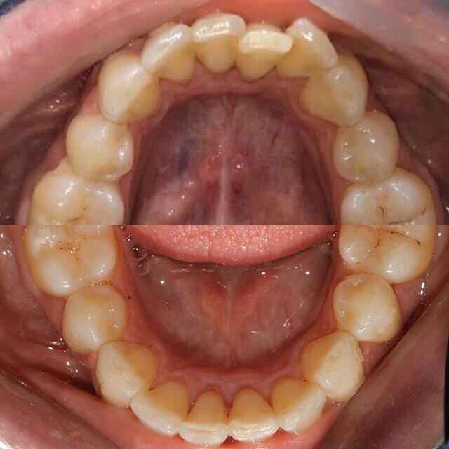 Simple, quick, effective. Happy patient following 9 weeks of Invisalign #clearaligners #cincodesmileo #braceyourself