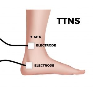 Percutaneous Tibial Nerve Stimulation (PTNS) and Transcutaneous Electrical  Nerve Stimulation (TENS)