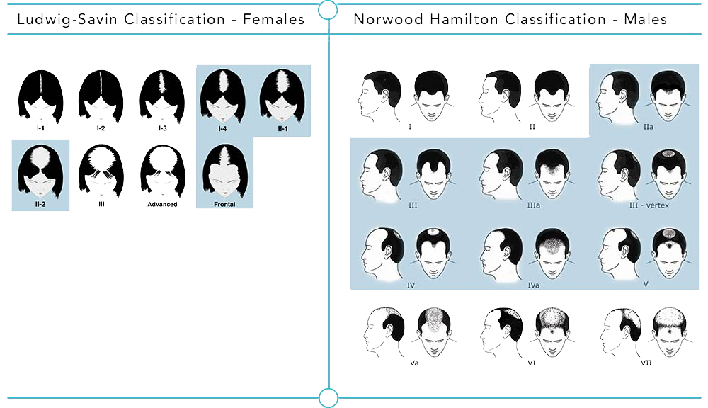 Hair Regeneration results vary depending on hair pattern classifications.